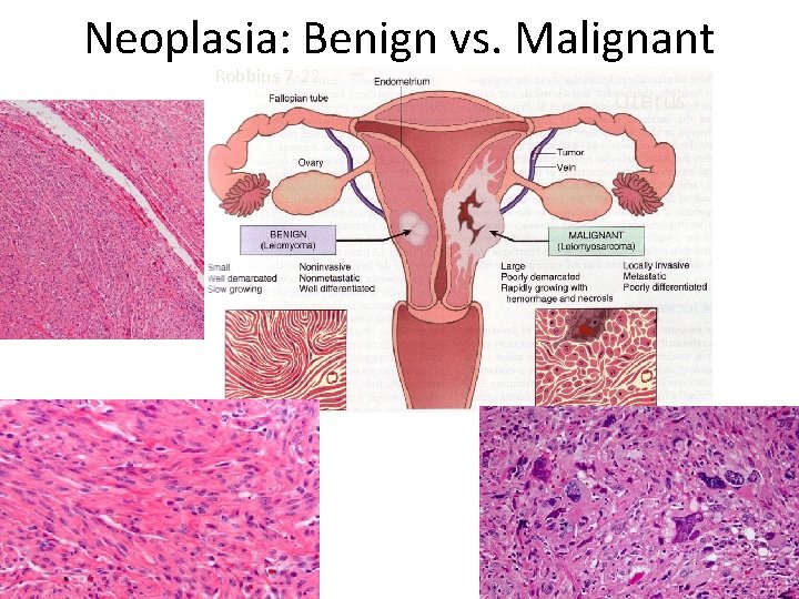 Neoplasia: Benign vs. Malignant Robbins 7 -22 Uterus 