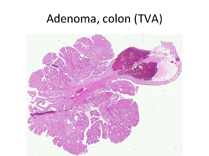 Adenoma, colon (TVA) 