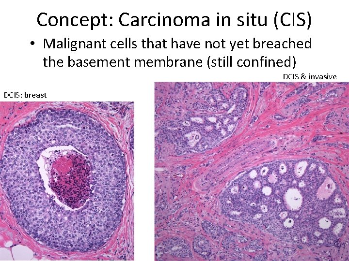 Concept: Carcinoma in situ (CIS) • Malignant cells that have not yet breached the