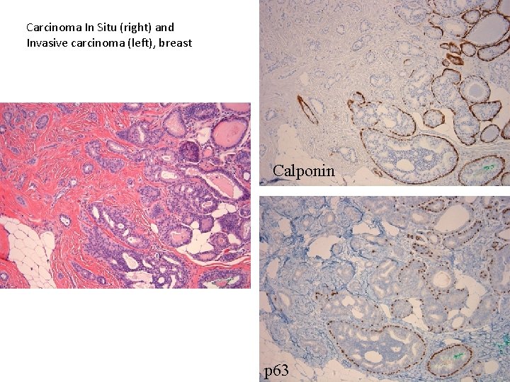 Carcinoma In Situ (right) and Invasive carcinoma (left), breast Calponin p 63 