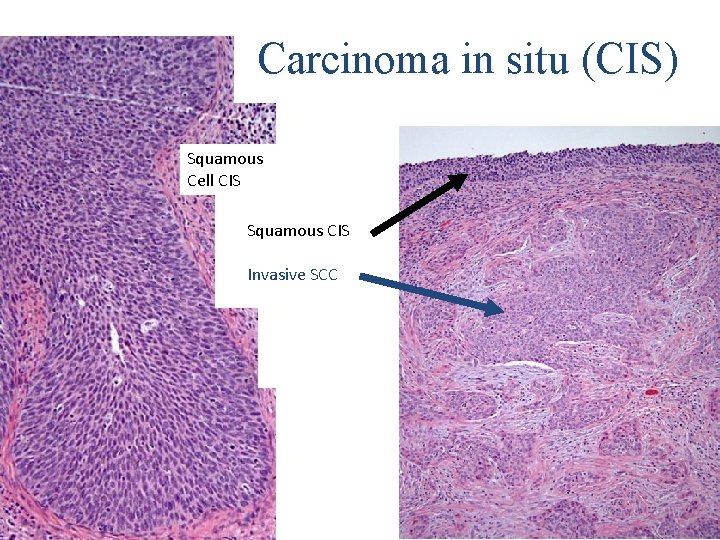 Carcinoma in in situ (CIS) Carcinoma Squamous Cell CIS Squamous CIS Invasive SCC 