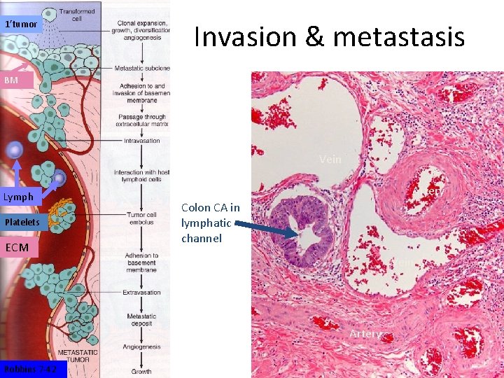 1’tumor Invasion & metastasis BM Vein Lymph Platelets ECM Artery Colon CA in lymphatic