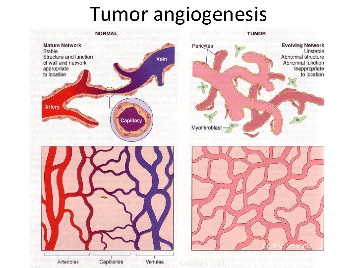 Tumor angiogenesis Leaky vessels Robbins 7 -41 