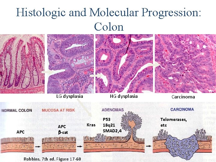 Histologic and Molecular Progression: Colon LG dysplasia APC b-cat Robbins. 7 th ed. Figure