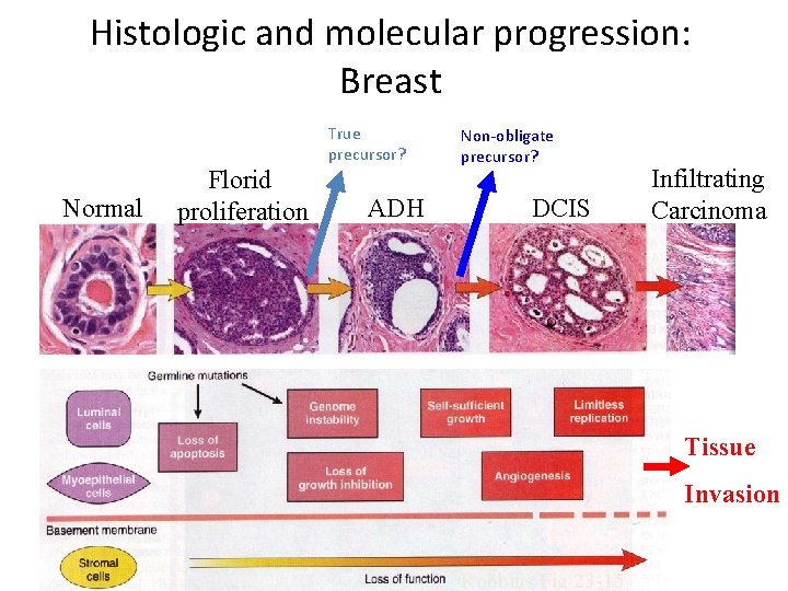 Histologic and molecular progression: Breast True precursor? Normal Florid proliferation ADH Non-obligate precursor? DCIS