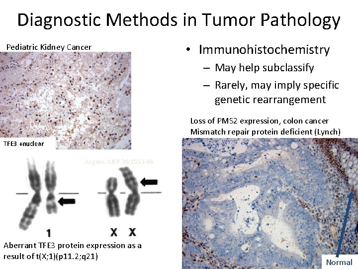 Diagnostic Methods in Tumor Pathology Pediatric Kidney Cancer • Immunohistochemistry – May help subclassify