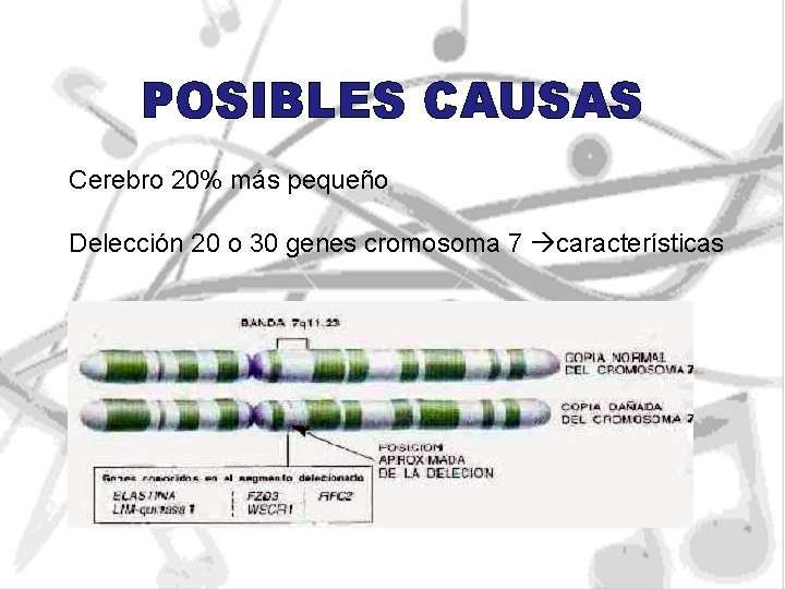 POSIBLES CAUSAS Cerebro 20% más pequeño Delección 20 o 30 genes cromosoma 7 características