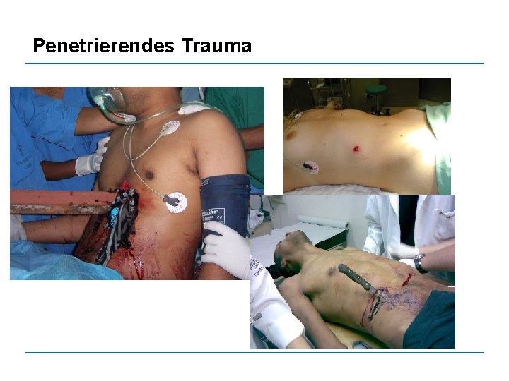 Penetrierendes Trauma 