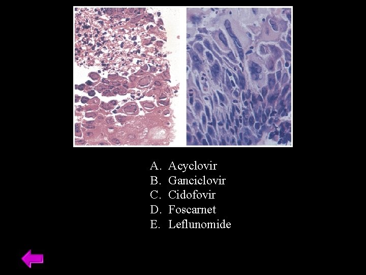 A. B. C. D. E. Acyclovir Ganciclovir Cidofovir Foscarnet Leflunomide 