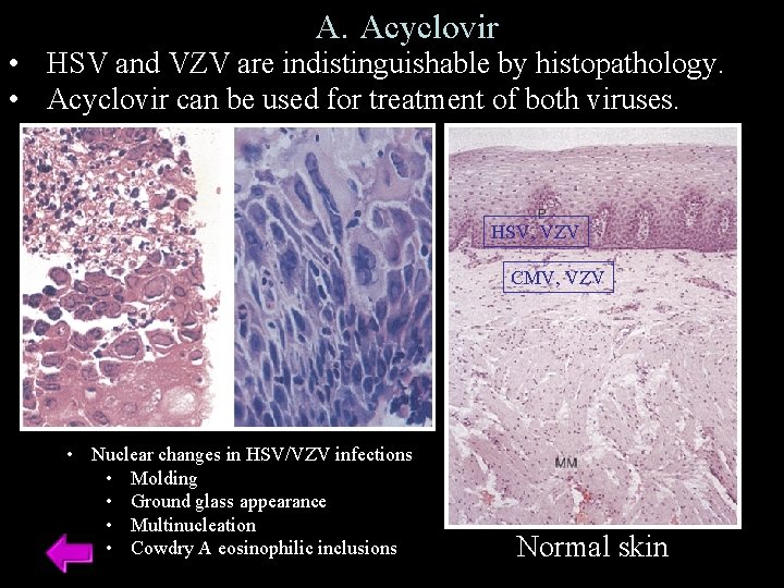 A. Acyclovir • HSV and VZV are indistinguishable by histopathology. • Acyclovir can be