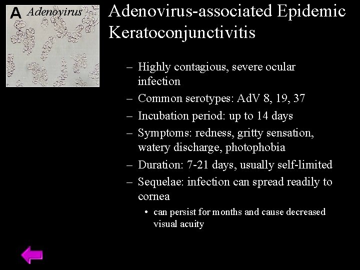 A Adenovirus-associated Epidemic Keratoconjunctivitis – Highly contagious, severe ocular infection – Common serotypes: Ad.