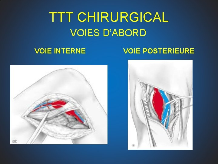 TTT CHIRURGICAL VOIES D’ABORD VOIE INTERNE VOIE POSTERIEURE 