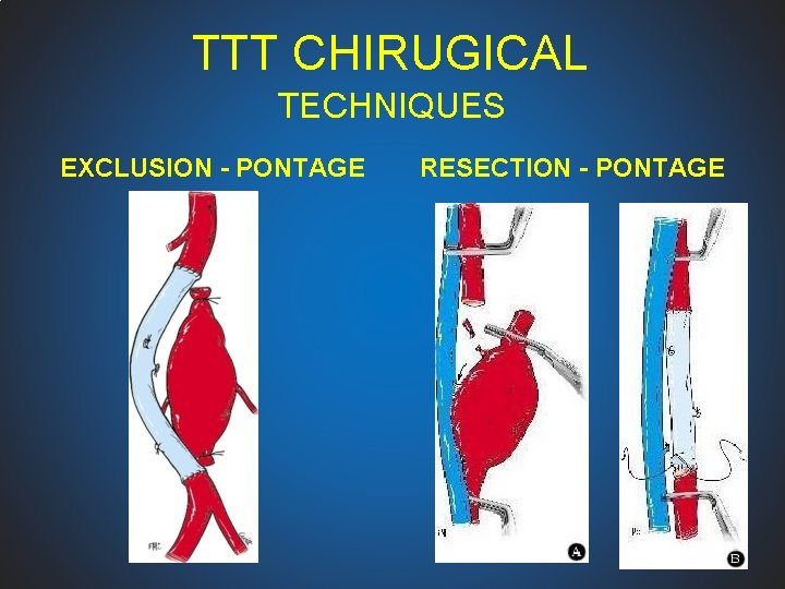 TTT CHIRUGICAL TECHNIQUES EXCLUSION - PONTAGE RESECTION - PONTAGE 