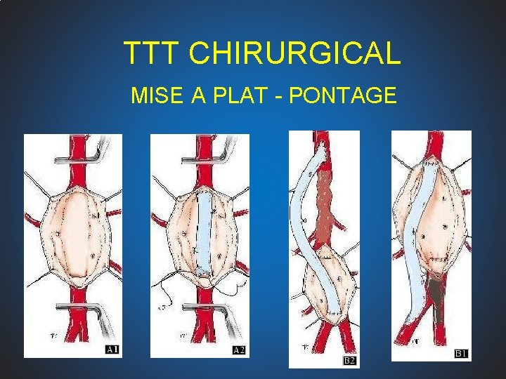 TTT CHIRURGICAL MISE A PLAT - PONTAGE 