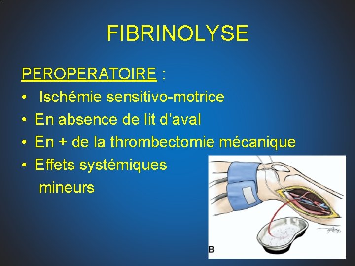 FIBRINOLYSE PEROPERATOIRE : • Ischémie sensitivo-motrice • En absence de lit d’aval • En