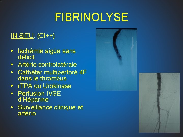 FIBRINOLYSE IN SITU: (CI++) • Ischémie aigüe sans déficit • Artério controlatérale • Cathéter