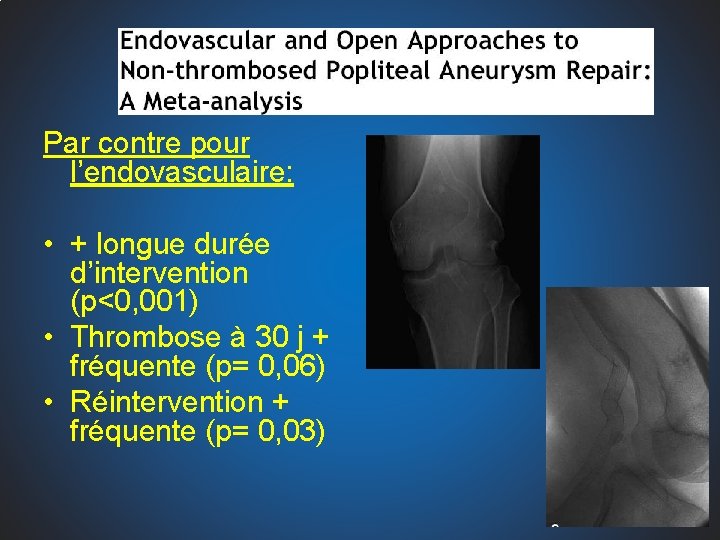 Par contre pour l’endovasculaire: • + longue durée d’intervention (p<0, 001) • Thrombose à