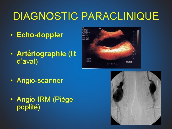 DIAGNOSTIC PARACLINIQUE • Echo-doppler • Artériographie (lit d’aval) • Angio-scanner • Angio-IRM (Piège poplité)