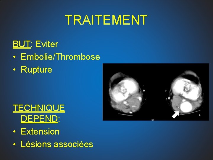 TRAITEMENT BUT: Eviter • Embolie/Thrombose • Rupture TECHNIQUE DEPEND: • Extension • Lésions associées