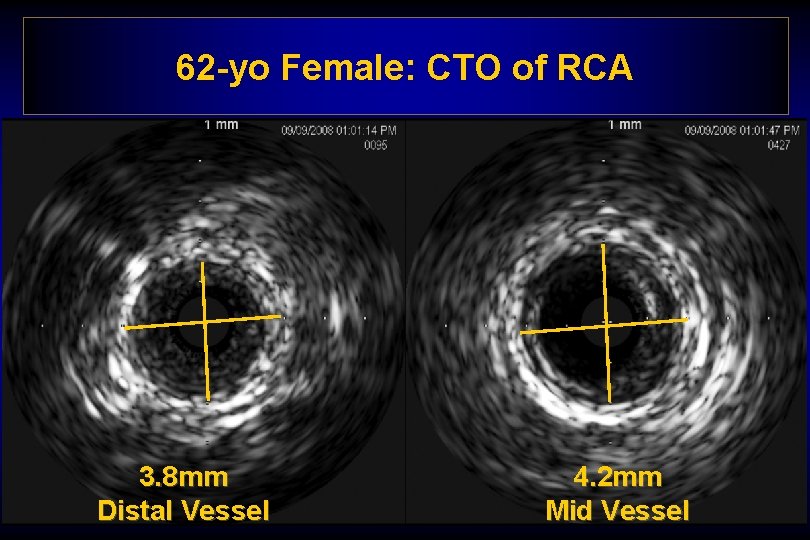 62 -yo Female: CTO of RCA 3. 8 mm Distal Vessel 4. 2 mm