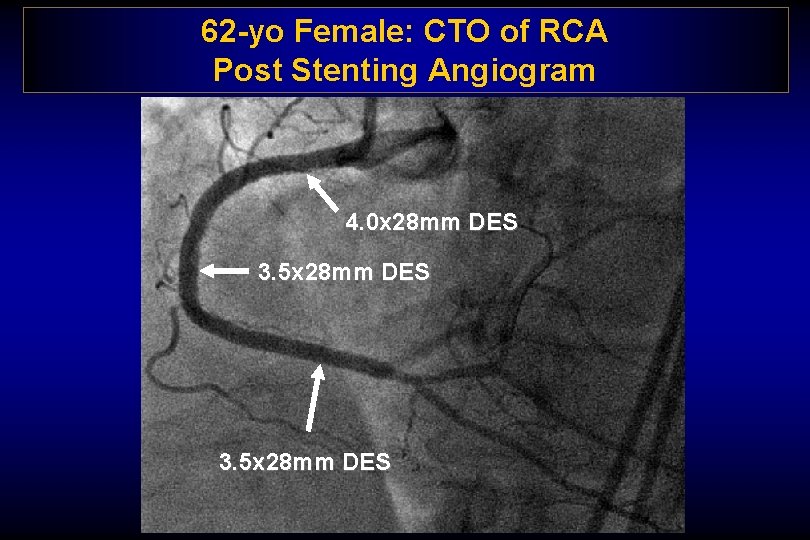 62 -yo Female: CTO of RCA Post Stenting Angiogram 4. 0 x 28 mm