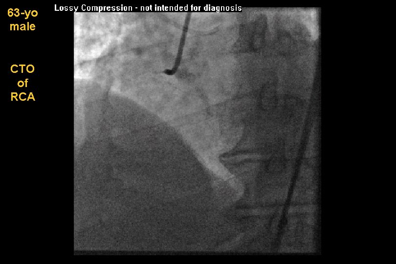 63 -yo male CTO of RCA 