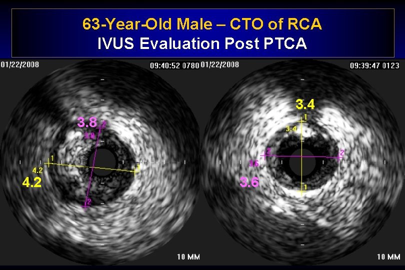 63 -Year-Old Male – CTO of RCA IVUS Evaluation Post PTCA 3. 4 3.