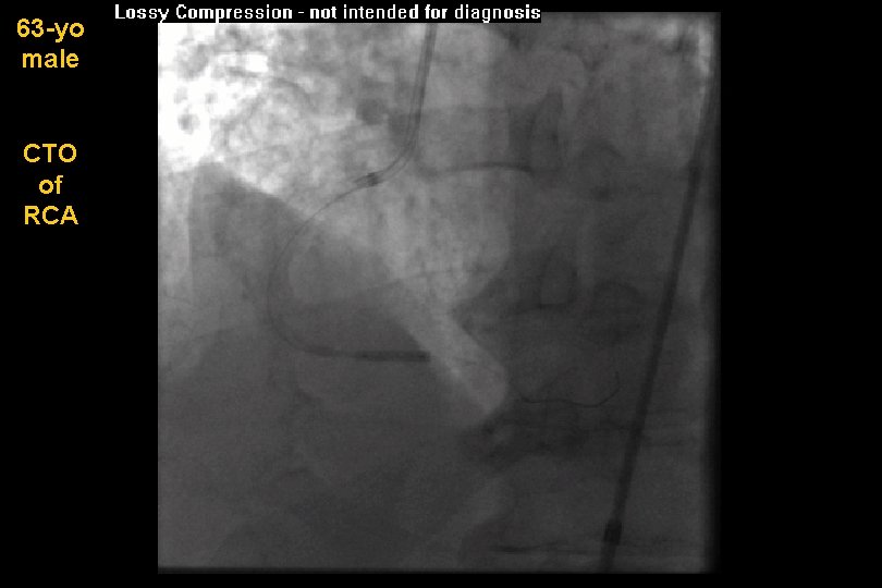 63 -yo male CTO of RCA 