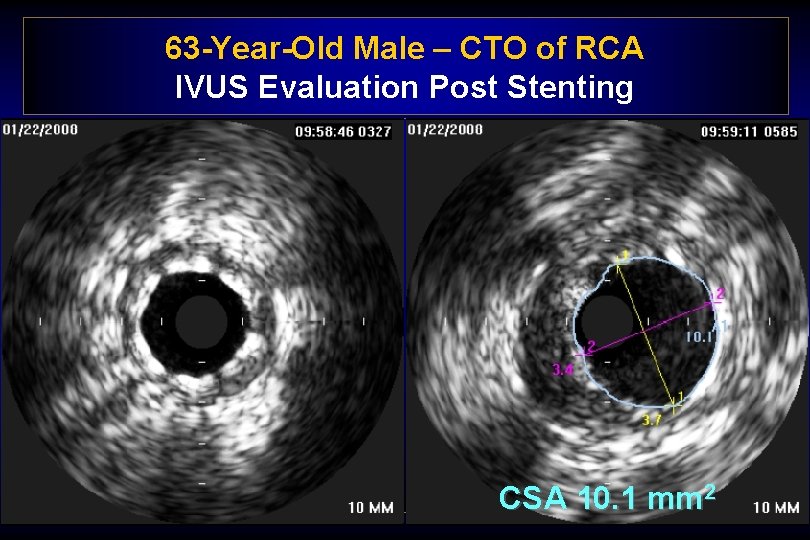 63 -Year-Old Male – CTO of RCA IVUS Evaluation Post Stenting CSA 10. 1