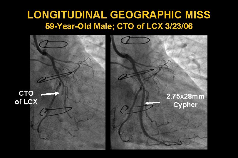 LONGITUDINAL GEOGRAPHIC MISS 59 -Year-Old Male; CTO of LCX 3/23/06 CTO of LCX 2.