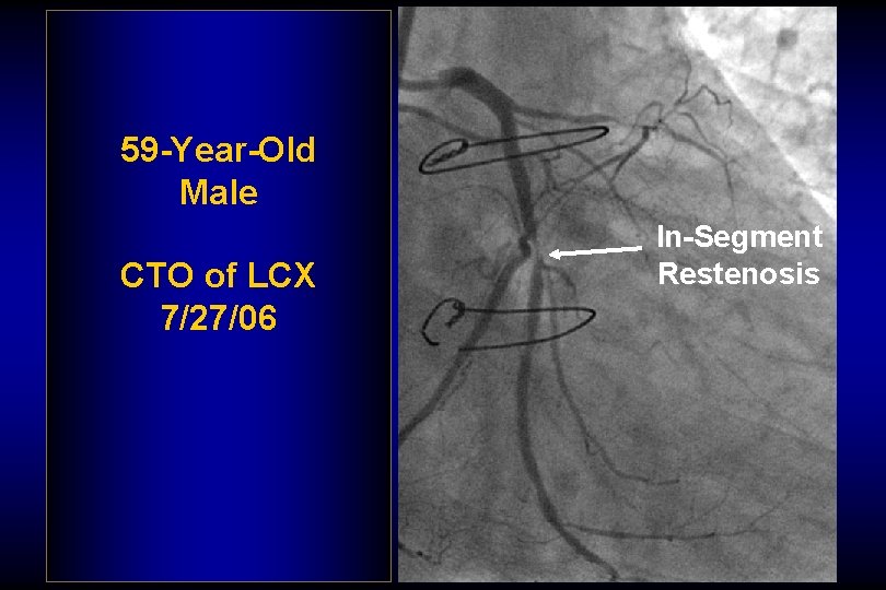 59 -Year-Old Male CTO of LCX 7/27/06 In-Segment Restenosis 