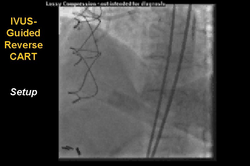 IVUSGuided Reverse CART Setup 