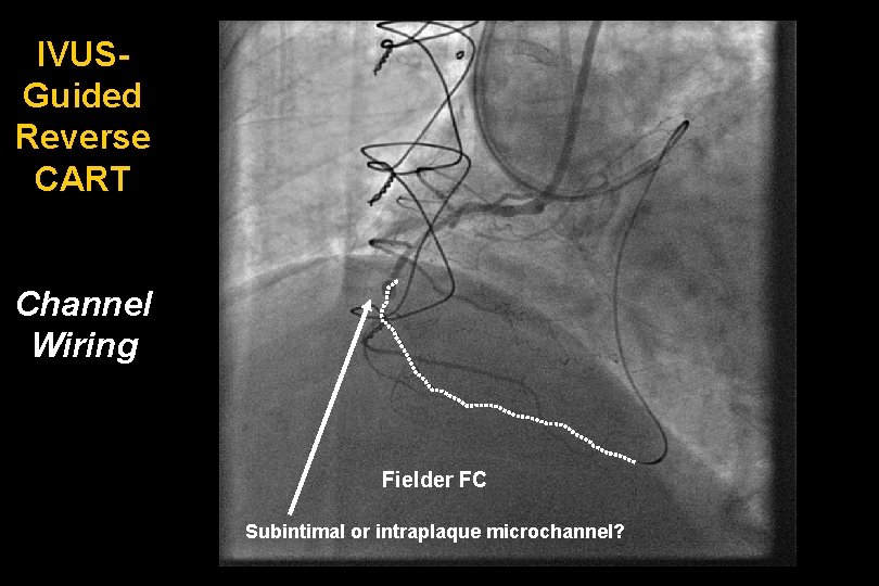 IVUSGuided Reverse CART Channel Wiring Fielder FC Subintimal or intraplaque microchannel? 