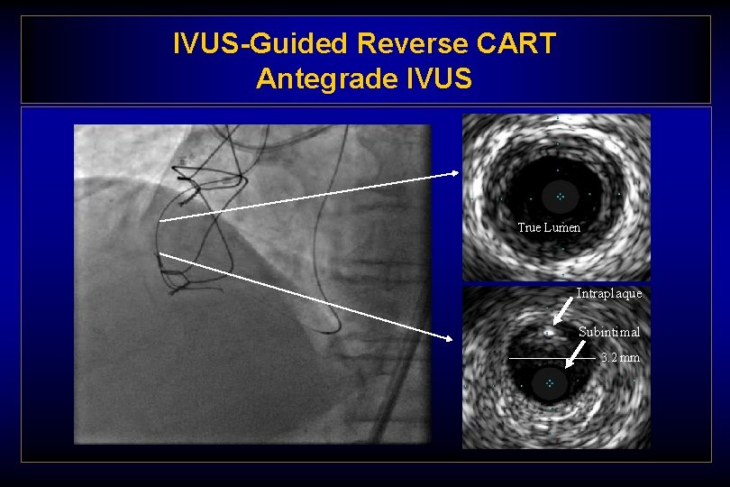 IVUS-Guided Reverse CART Antegrade IVUS True Lumen Intraplaque Subintimal 3. 2 mm 