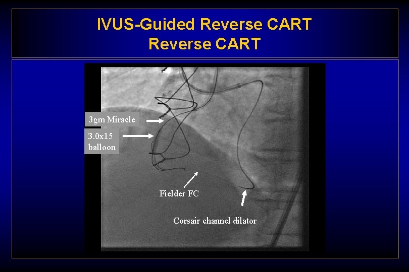 IVUS-Guided Reverse CART 3 gm Miracle 3. 0 x 15 balloon Fielder FC Corsair