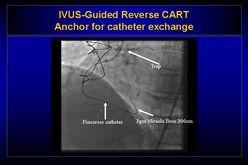 IVUS-Guided Reverse CART Anchor for catheter exchange Trap Finecross catheter 3 gm Miracle Bros