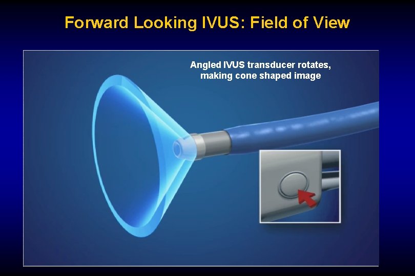 Forward Looking IVUS: Field of View Angled IVUS transducer rotates, making cone shaped image