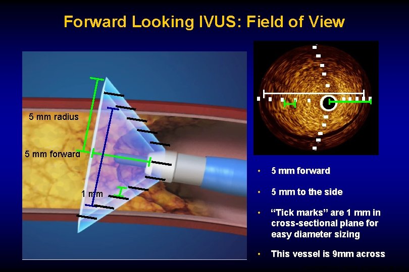 Forward Looking IVUS: Field of View 5 mm radius 5 mm forward 1 mm