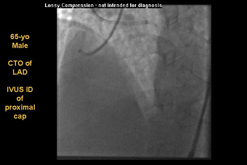 65 -yo Male CTO of LAD IVUS ID of proximal cap 