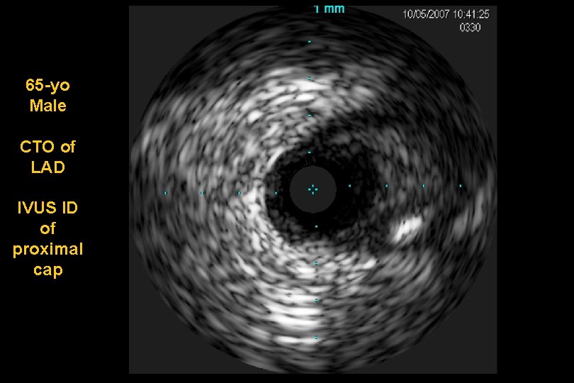 65 -yo Male CTO of LAD IVUS ID of proximal cap 