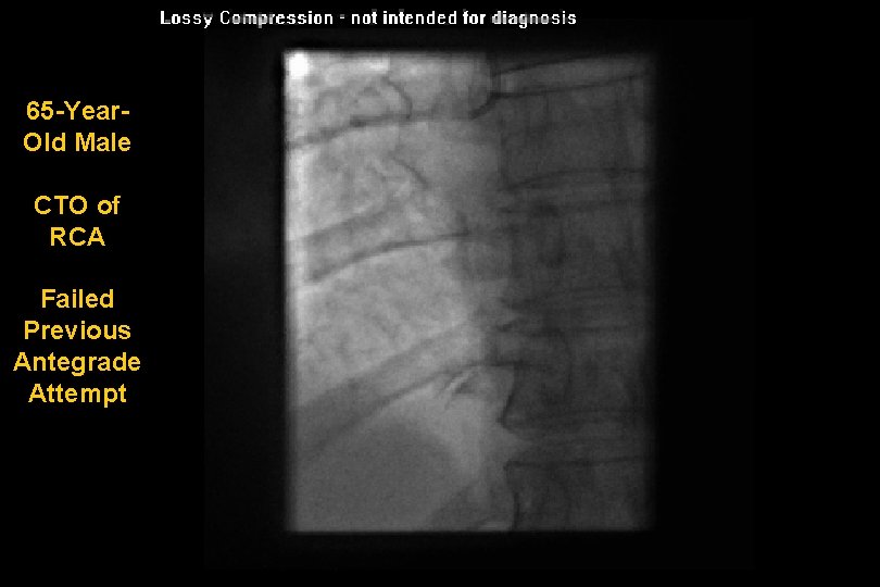 65 -Year. Old Male CTO of RCA Failed Previous Antegrade Attempt 