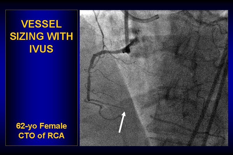 VESSEL SIZING WITH IVUS 62 -yo Female CTO of RCA 