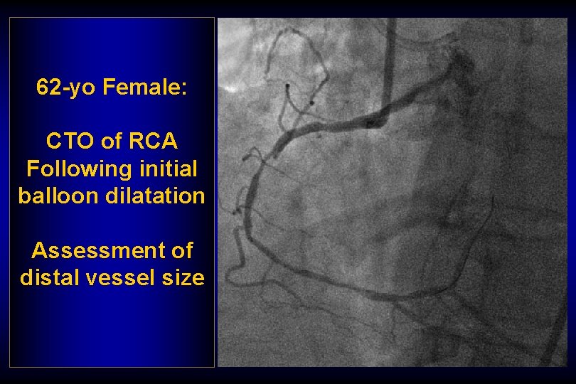 62 -yo Female: CTO of RCA Following initial balloon dilatation Assessment of distal vessel