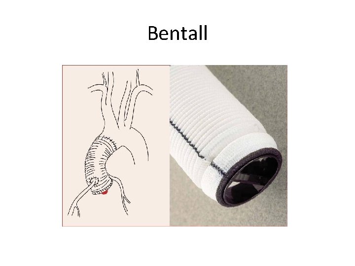 Bentall 