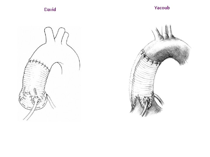 David Yacoub 