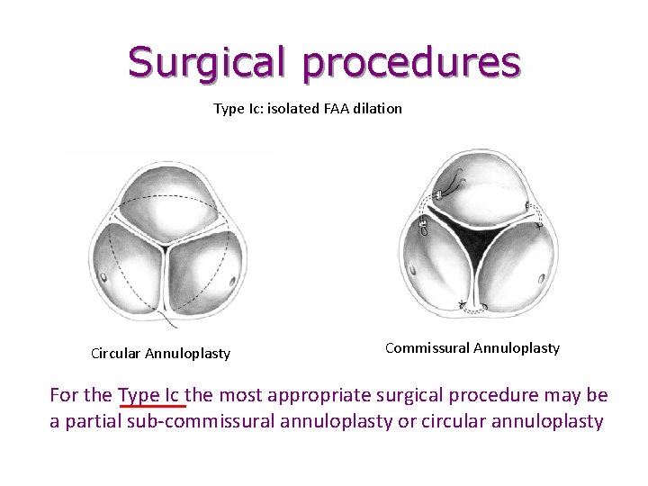 Surgical procedures Type Ic: isolated FAA dilation Circular Annuloplasty Commissural Annuloplasty For the Type