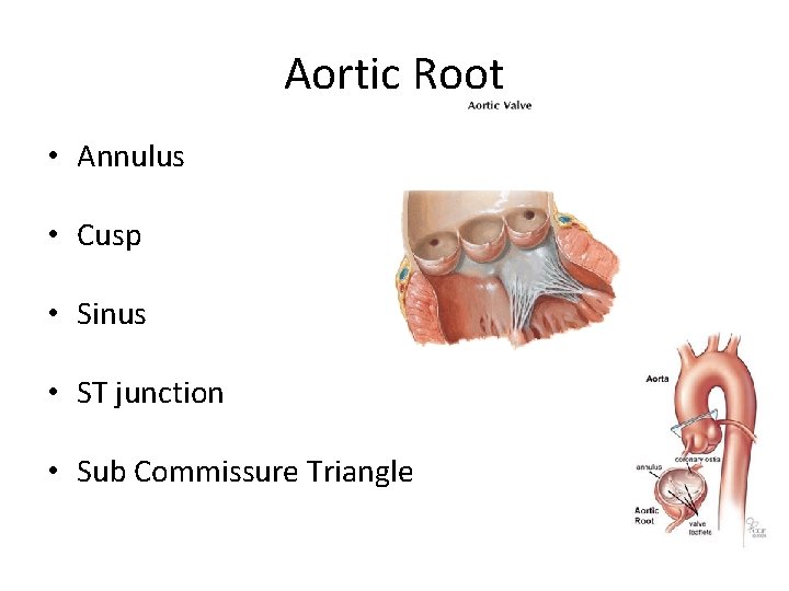 Aortic Root • Annulus • Cusp • Sinus • ST junction • Sub Commissure