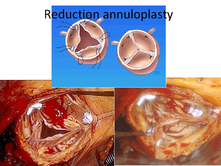 Reduction annuloplasty 