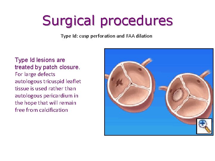 Surgical procedures Type Id: cusp perforation and FAA dilation Type Id lesions are treated