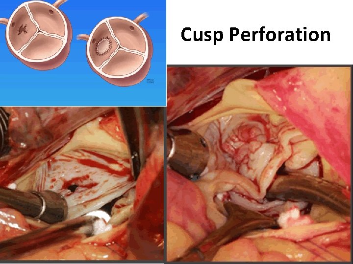 Cusp Perforation 